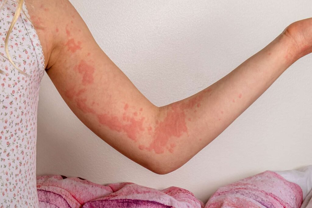 Skin Rashes or Itching